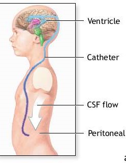 Ventriculoperitoneal (VP) Shunt Procedure