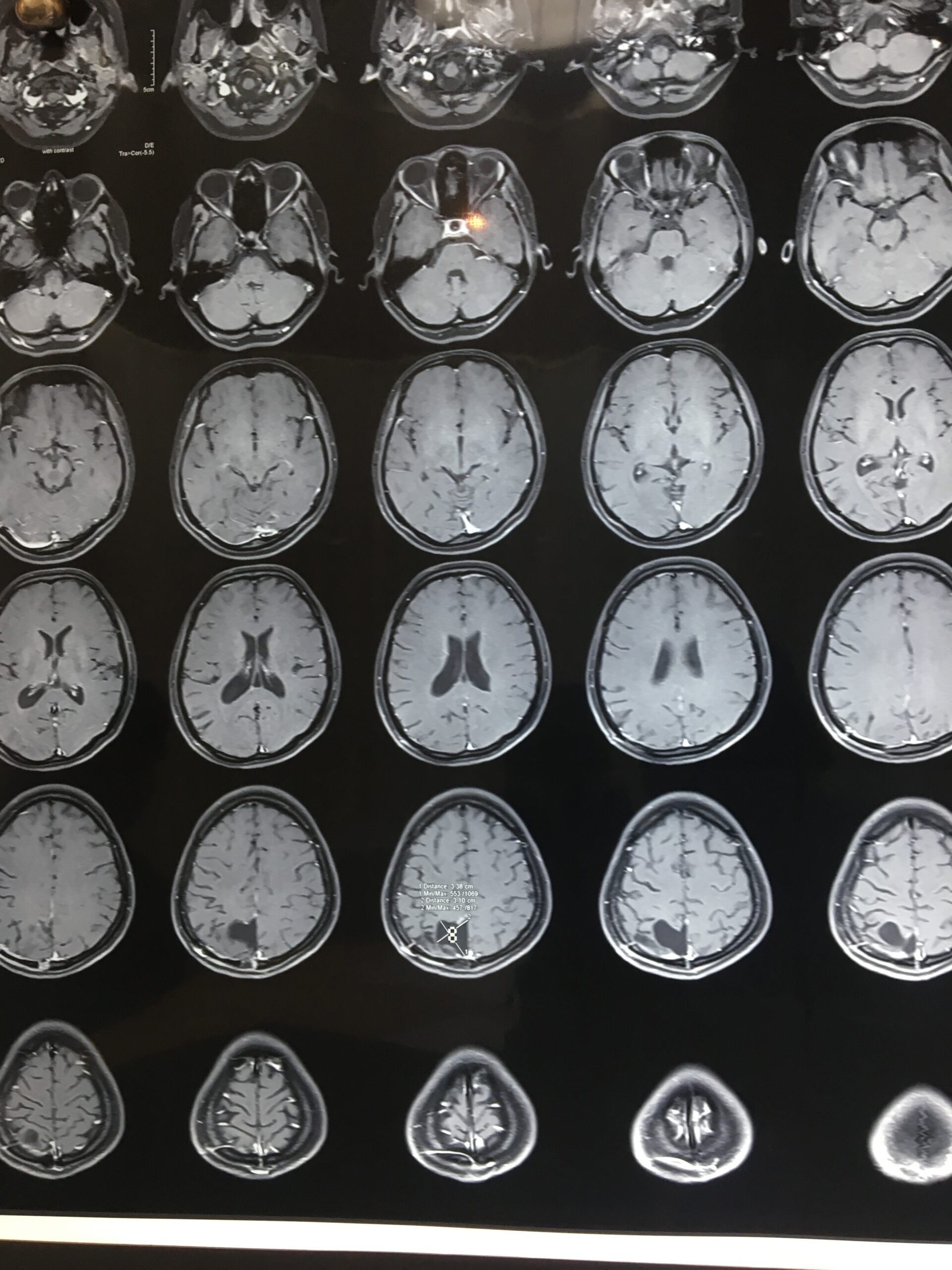 Brain MRI Contrast Series - Intracranial Lesion