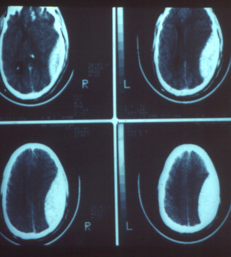 Epidural Hematoma Brain CT Scan