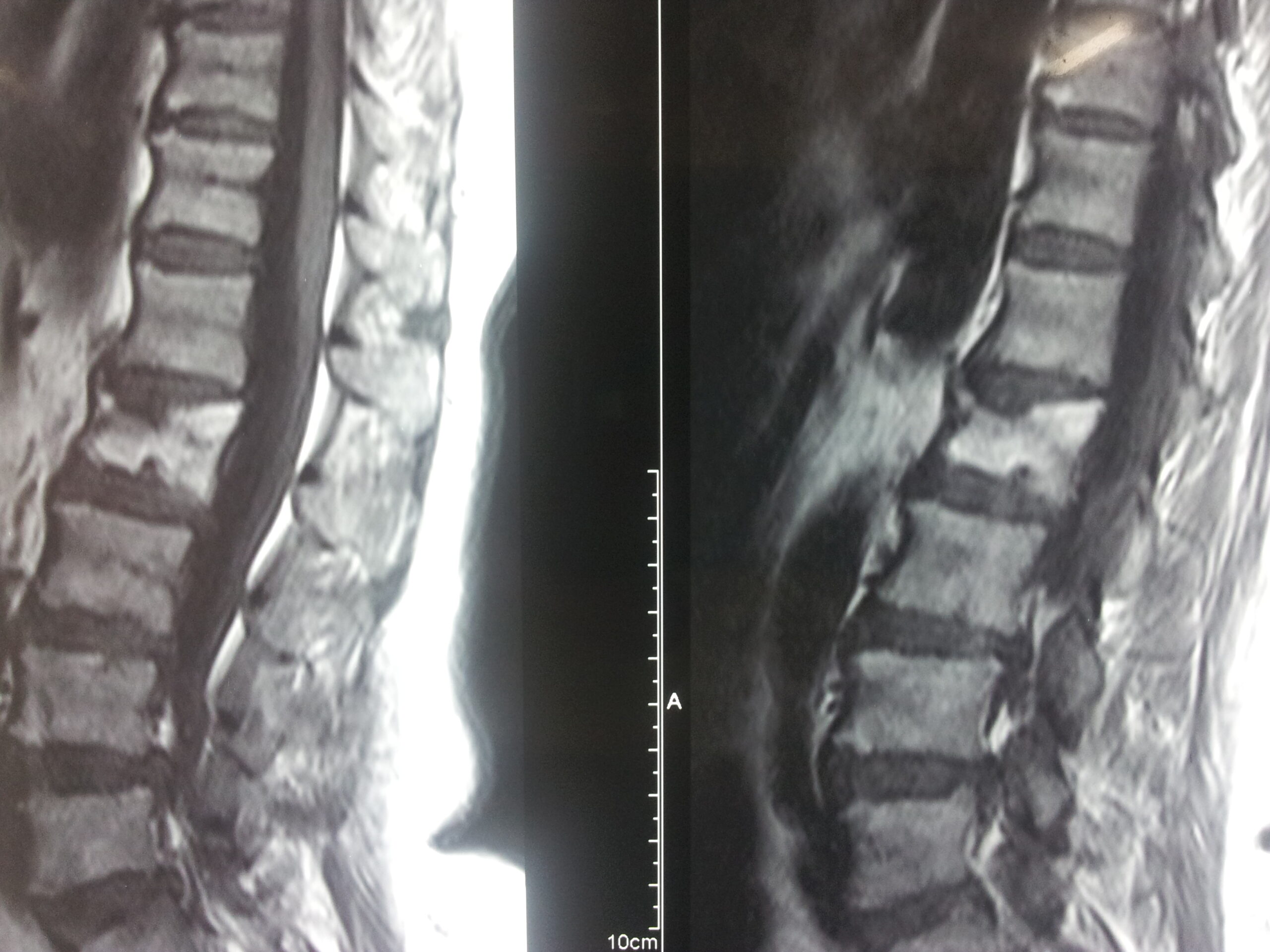 Thoracolumbar Spine MRI - Compression Fracture