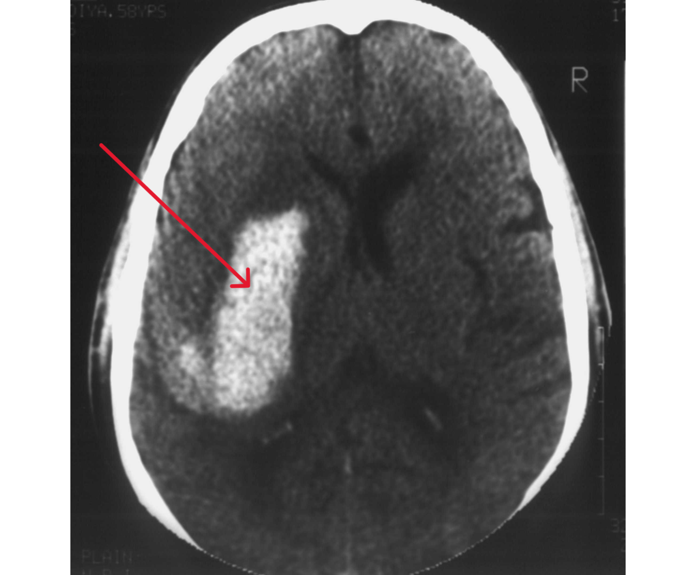 Intracerebral Hemorrhage (ICH) CT Scan