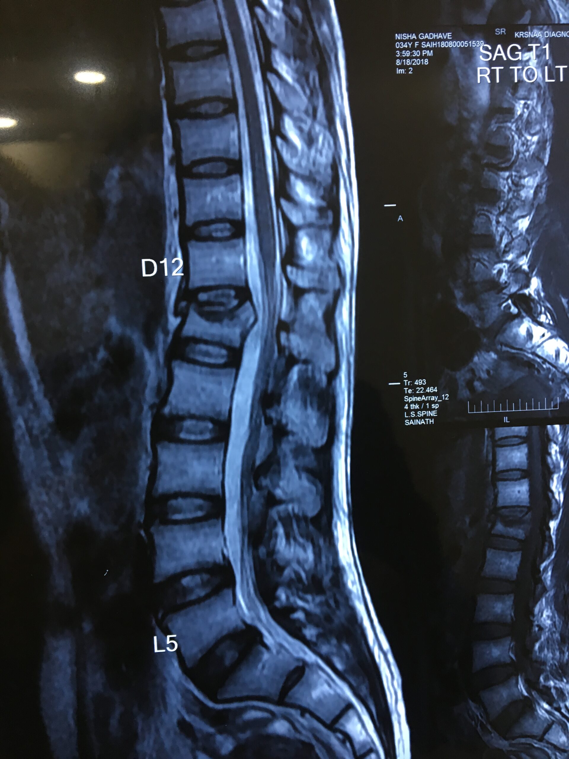 D12 Vertebral Fracture MRI