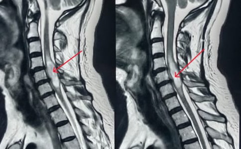 Cervical Cord Myelopathy MRI