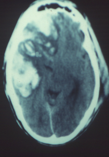 Head Injury & Hemorrhage CT Scan