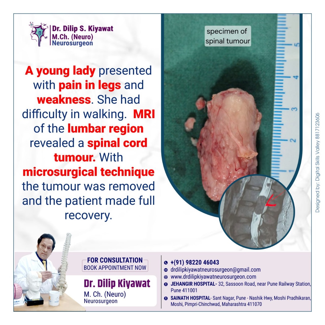 Microsurgical Removal of Spinal Cord Tumour