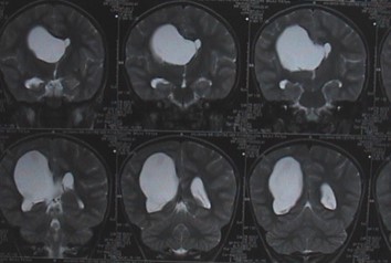 Marked Hydrocephalus Coronal MRI