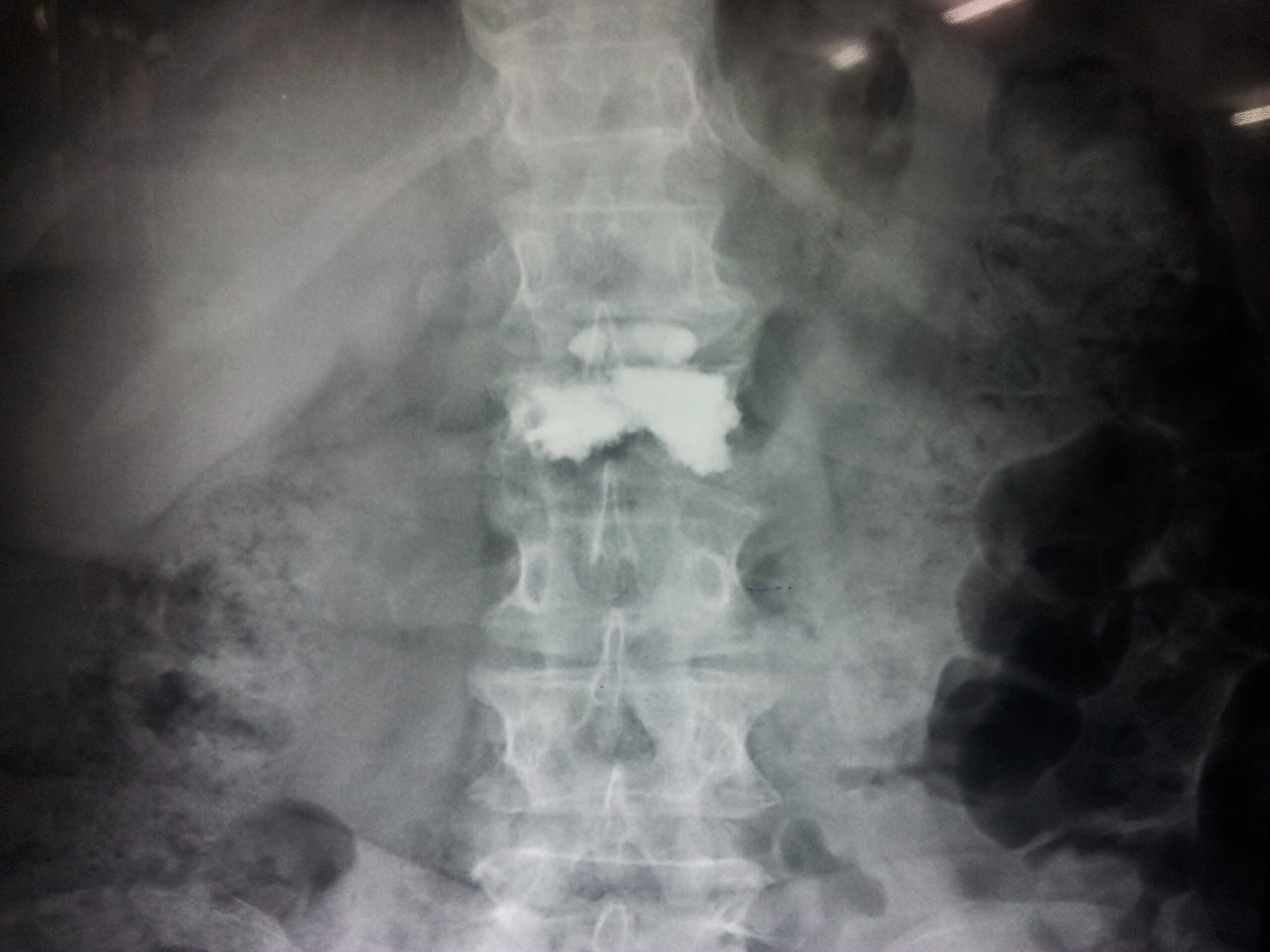 Vertebroplasty Cement Augmentation X-Ray