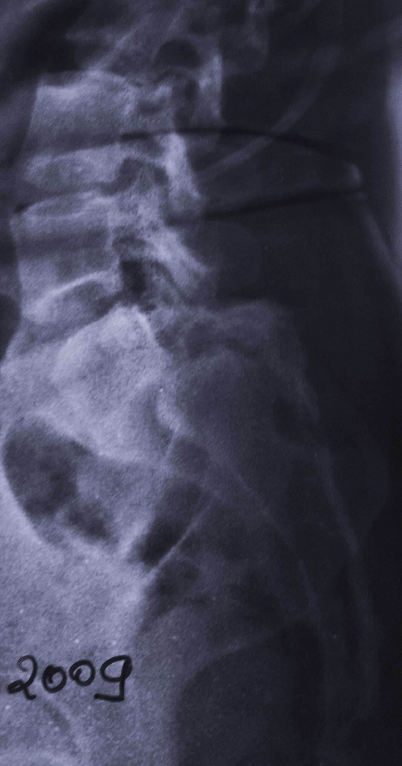Cervical Spine Radiograph