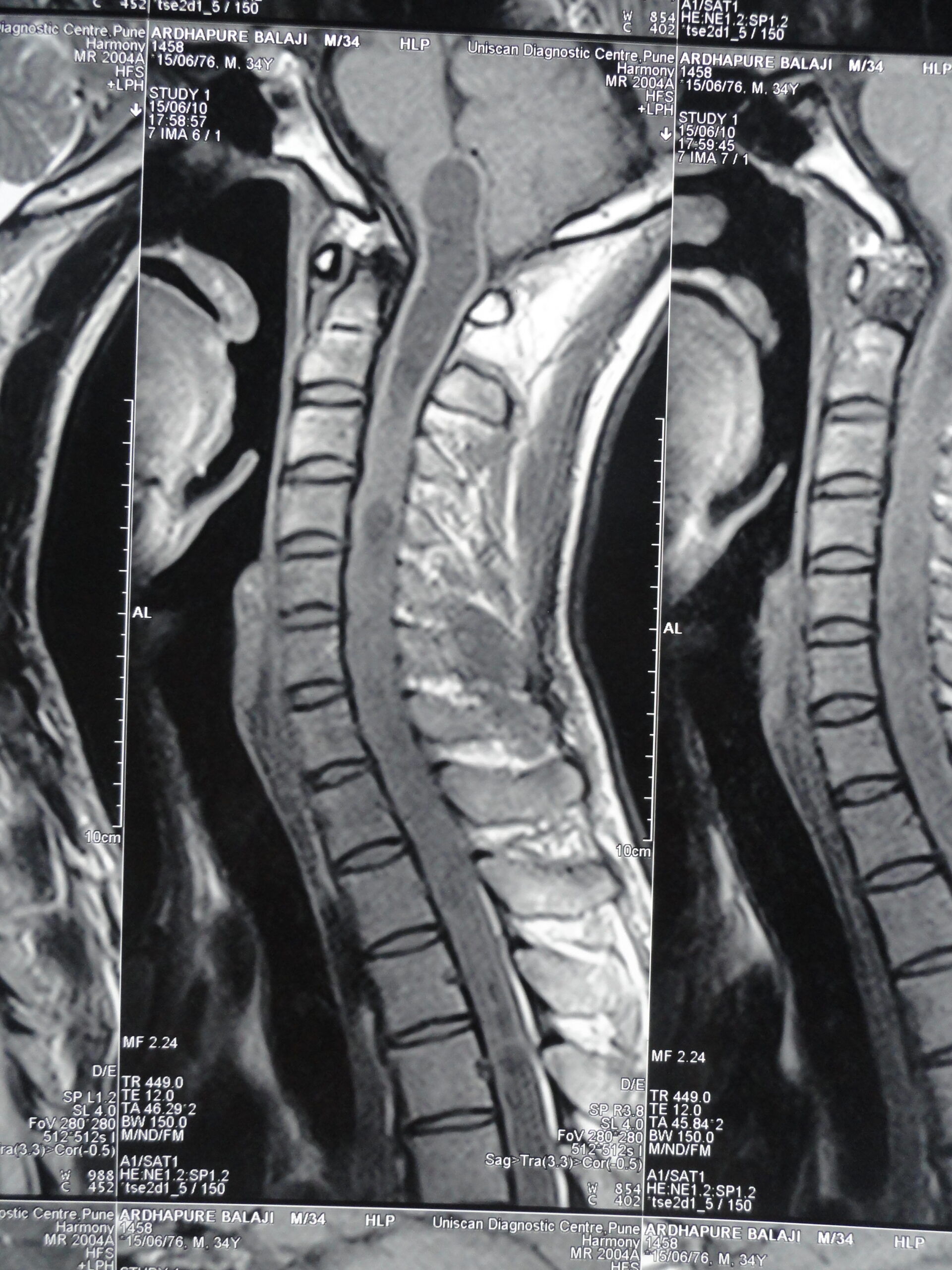 Sagittal Cervical MRI - Syringomyelia