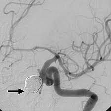 Cerebral Angiogram (DSA) - Aneurysm Coiling