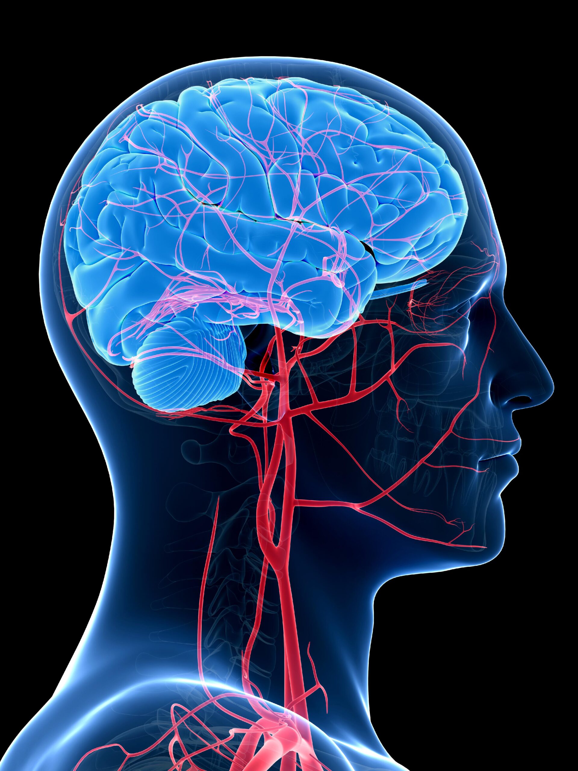 Arteriovenous Malformation Vascular Anatomy Illustration
