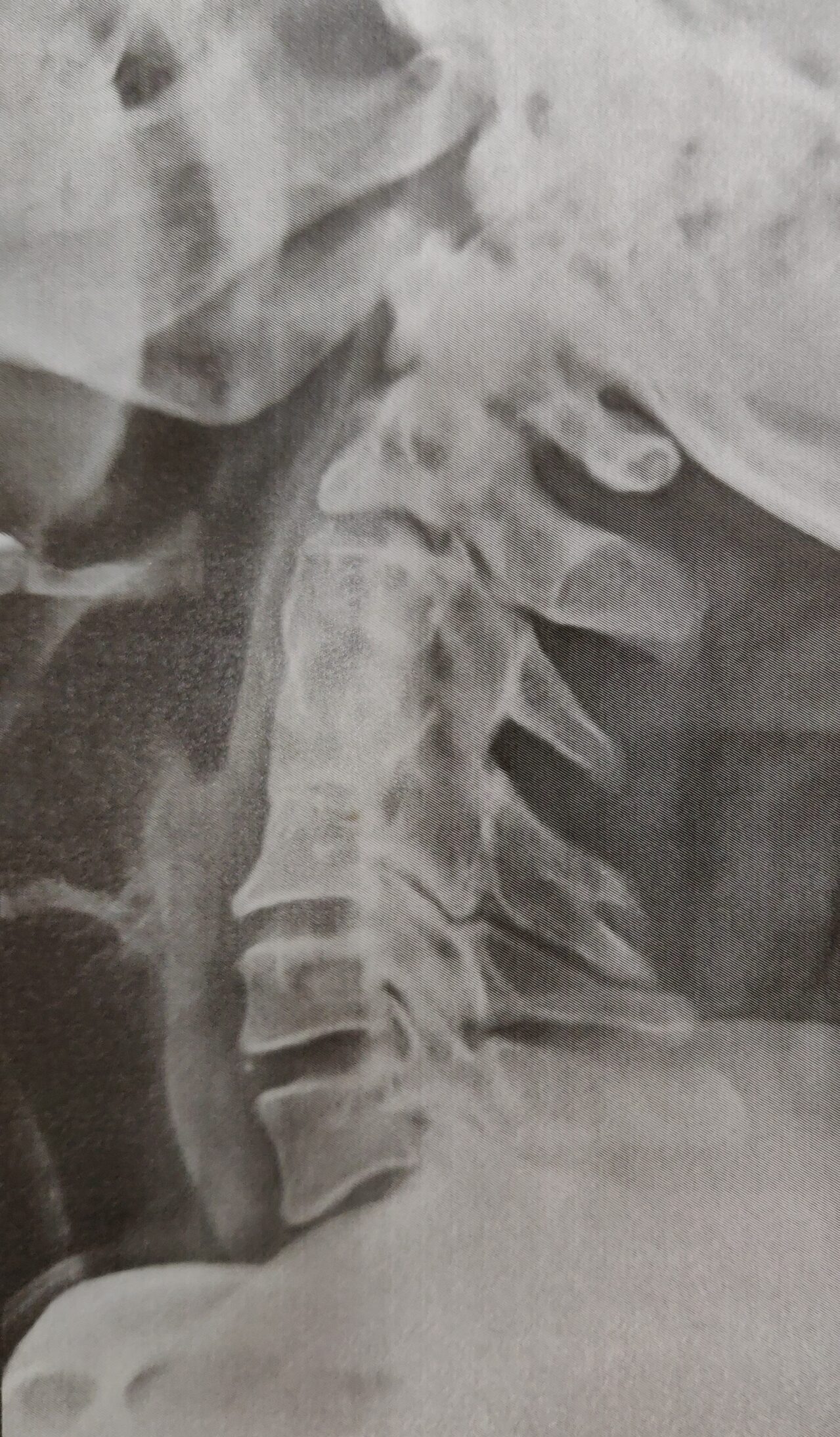 Post Operative X-Ray Showing good spinal fusion with bone graft