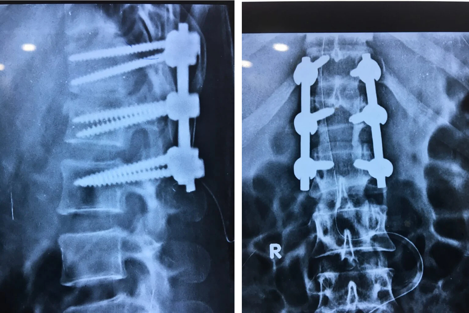 Correction of fracture & Stabilization of L-1 Body Fracture
