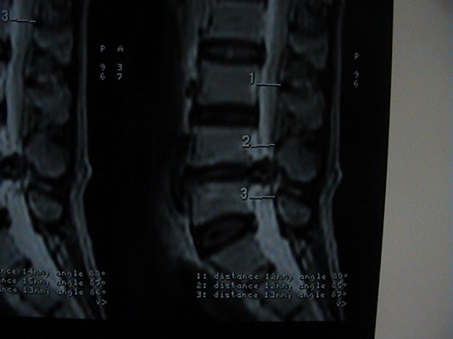 L 4 - L 5 Slip Disc seen on mri