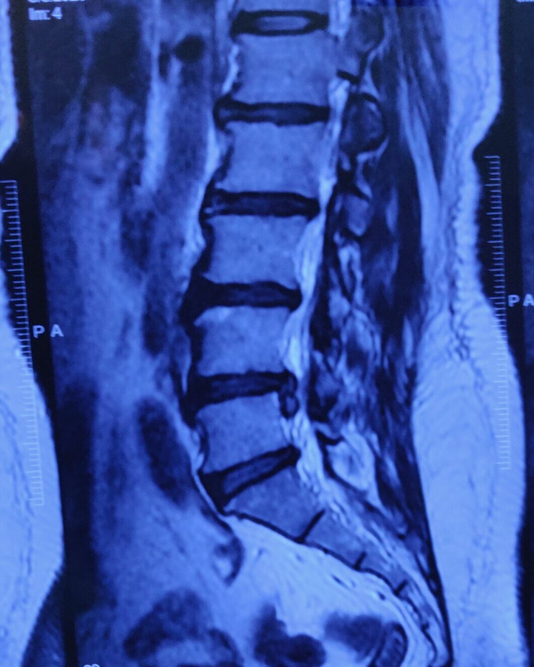 l4/l5 disc prolapse