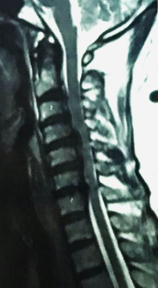 Ossified Posterior Longitudinal Ligament (Opll) causing compression of spinal cord