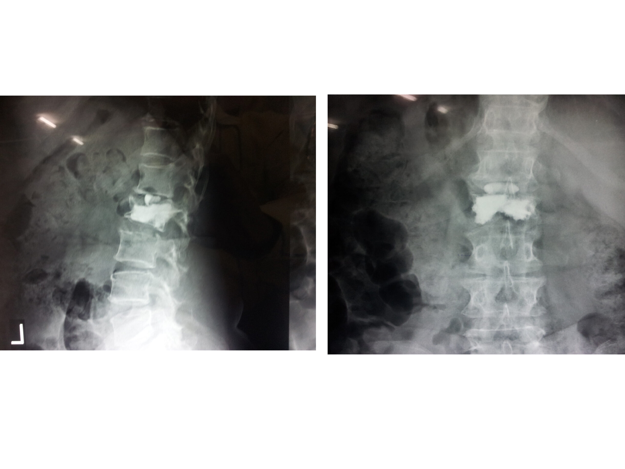 Vertebroplasty of L 2 done