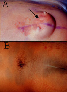 Spinal Dysraphism Meningomyelocele Anatomy