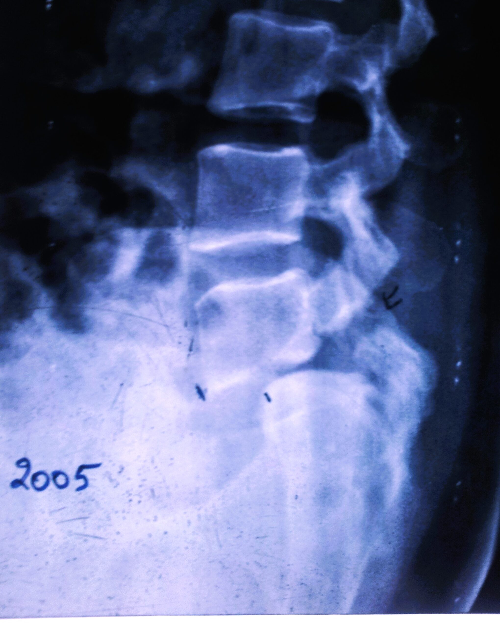 Spondylolisthesis AT L5-S1 LEVEL DUE TO FRACTURE